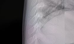 Kahramanmaraş'ta Bebeğin Sırtından Tel Parçası Çıktı