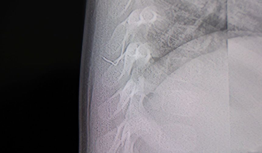 Kahramanmaraş'ta Bebeğin Sırtından Tel Parçası Çıktı