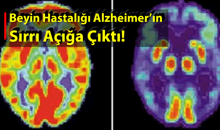 Beyin Hastalığı Alzheimer'ın Sırrı Açığa Çıktı!